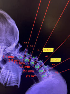 Computerized Spinal Ligament Assessment Three