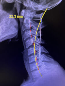 Computerized Spinal Ligament Assessment One