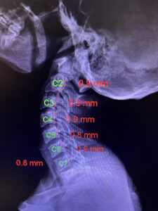 Computerized Spinal Ligament Assessment Two